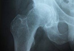 Osteoarthritis x-ray